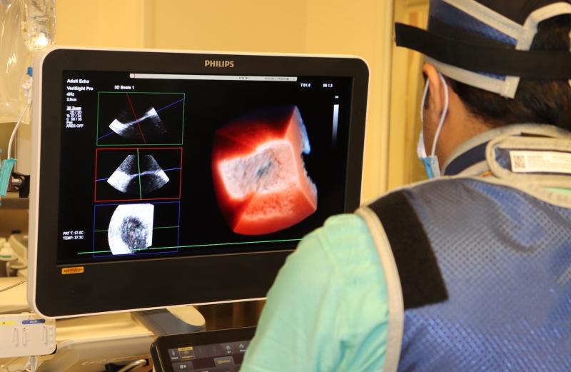 A live, 3-D intra-cardiac echo (ICE) ultrasound image from inside the atrium of the heart taken during the first cryoablation EP procedure performed using the technology at Northwestern Medicine. The new Philips Healthcare VeriSight Pro ICE catheter offers superior 2-D and 3-D live image guidance for a wide range of procedures in structural heart disease and electrophysiology (EP), allowing interventionalists to navigate procedures.
