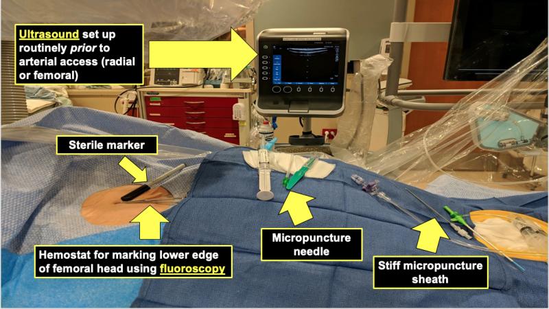 At Mayo, they have a small, tableside-mounted ultrasound console in the cath labs that is used for both radial and femoral vascular access. Table set up with the patient includes a sterile marker, a hemostat for marking the lower edge of the femoral head using fluoroscopy, a micropunture needle, and a still micropunture sheath.