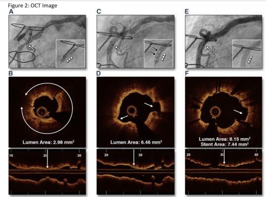 A comparison showing angiography and optical coherence tomography (OCT) views of an undilated mid right coronary artery calcified lesion, post dilation with the Shockwave intravascular lithotripsy system, and the final result after stenting. The technology allows calcified lesions to be broken up without the need for vessel trauma caused by high pressure balloons or atherectomy.Â