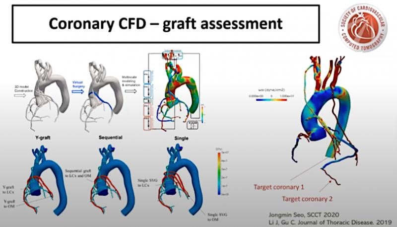 Sheer stresses on the walls of arteries are believed to cause the formation atherosclerotic plaques. This is an area of research that is expected to see increased use in the next few years. This study was presented at SCCT 2020 as an example of how sheer stresses can help evaluate and predict the patency of coronary artery bypass grafts (CABG). #SCCT2020 #yesCCT