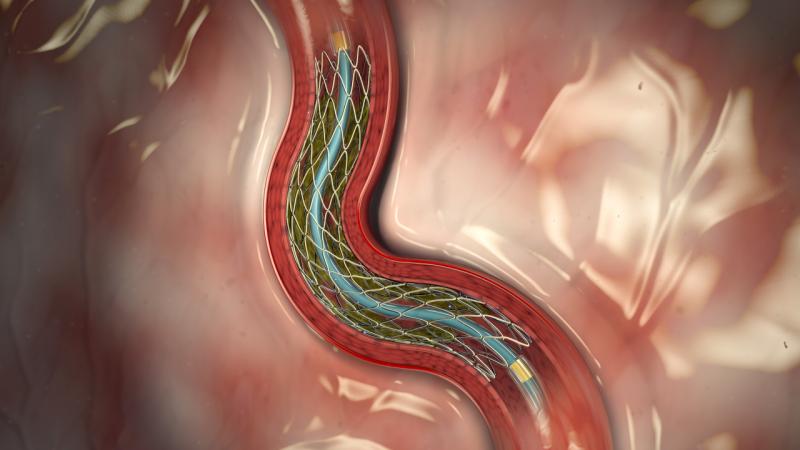 The Medtronic Resolute Integrity drug-eluting stent is among the top three stents on the U.S. market. Outcomes for these stents are very similar, so the stents have largely become a commodity product purchased on price rather than clinical data. Stent advances and new stent technologies.