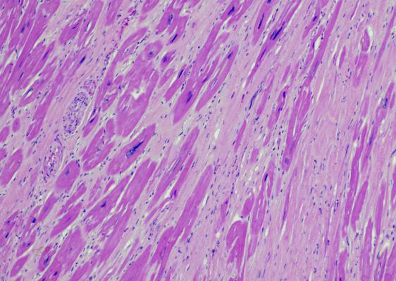 Lahey Health Medical Center Investigator Leads Phase 3 trial demonstrating novel therapy enhances exercise capacity, improves symptoms in patients obstructive HCM