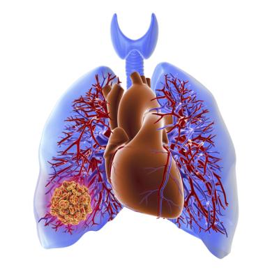 Six-month outcomes from the FlowTriever All-Comer Registry for Patient Safety and Hemodynamics (FLASH) registry were presented on May 19 as late-breaking clinical research at the Society for Cardiovascular Angiography & Interventions (SCAI) 2023 Scientific Sessions.
