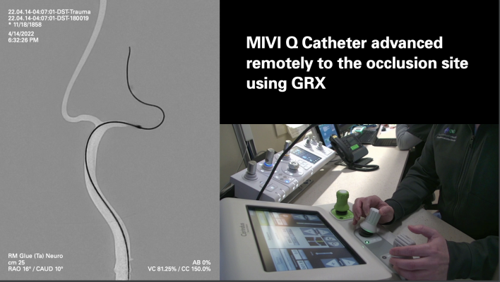 The MIVI Neuroscience Q Aspiration Catheter incorporates a novel pusher wire design on its proximal end. This feature has demonstrated in simulated use studies that the Q Catheter may be uniquely suited to allow physicians in the future to treat ischemic stroke patients remotely via a robot from a different room, a different city, or even a different country.