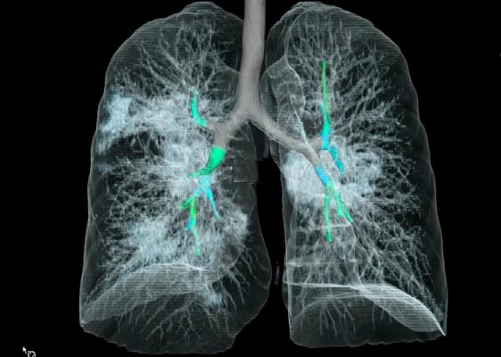 A 3-D rendering created from the chest CT scan of a 41-year-old coronavirus patient in China showing ground-glass opacities in several areas of the lungs from the coronavirus pneumonia. This was from one of the first medical imaging studies published on COVID-19 in the journal Radiology. #coronavirus #COVID2019 #COVID19 #2019nCoV #SARS‐CoV‐2
