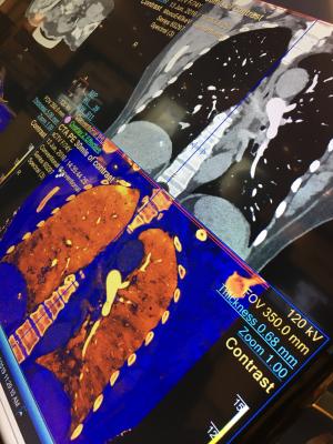 An example of spectral CT imaging from Philips showing an iodine map with dark areas in the lower lungs, which make pulmonary embolisms easier to visualize. #SCCT19 Example of dual-energy imaging in PE.