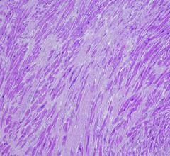 Bristol Myers Squibb has announced that it will present data on CAMZYOS (mavacamten) for NYHA class II-III obstructive hypertrophic cardiomyopathy at the American College of Cardiology (ACC) Annual Scientific Session & Expo, ACC.24, taking place April 6-8, 2024 in Atlanta, Georgia.
