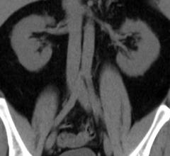 blood urea nitrogen, BUN, postoperative stroke, risk, test, Wake Forest Baptist