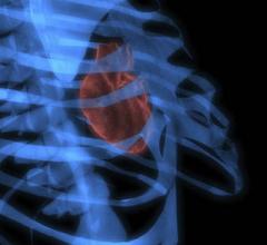 The Society of Cardiovascular Computed Tomography (SCCT) has released a new expert consensus document on Coronary Artery Disease 