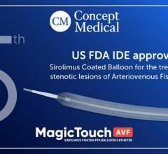 Concept Medical has received FDA IDE Approval for a US Clinical Study of its MagicTouch AVF, its Sirolimus drug-coated balloon (DCB) catheter..