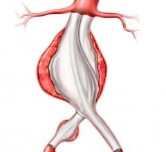 Endologix Ends Unrestricted Sales and Use of Nellix System