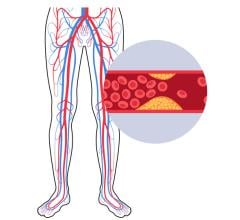 A recent publication in the American Heart Association Circulation highlights a comprehensive investigation to assess the impact of revascularization strategies on the health-related quality of life (HRQoL) of patients suffering from chronic limb-threatening ischemia 