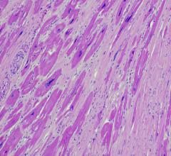Lahey Health Medical Center Investigator Leads Phase 3 trial demonstrating novel therapy enhances exercise capacity, improves symptoms in patients obstructive HCM