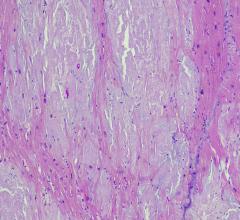 Life Molecular Imaging (LMI) announced that the first patient has been imaged with [18F]florbetaben in the CArdiag Phase 3 clinical study 