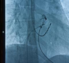 Study will evaluate the safety and effectiveness of the OMNYPULSE Pulsed Field Ablation (PFA) platform with integrated mapping 