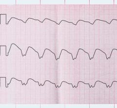 A first-in-human multicenter trial involving Mayo Clinic used a new ablation technique for patients with ventricular tachycardia, an abnormally rapid heart rhythm that is a leading cause of sudden cardiac death worldwide 