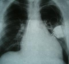 The first clinical trial to challenge the routine implantation of a defibrillator in myocardial infarction survivors with heart failure has enrolled its first patient. 