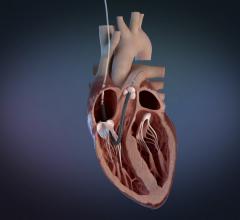 Abiomed is recalling the labeling for Impella RP Flex with Smart Assist System Catheter 