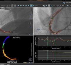 Medis QAngio XA 3D Receives FDA 510k Clearance