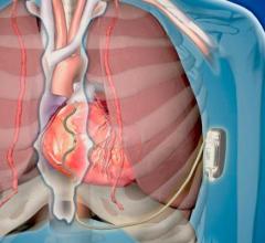 Medtronic plc has received CE (Conformité Européenne) Mark for the Aurora EV-ICD MRI SureScan (Extravascular Implantable Cardioverter-Defibrillator) and Epsila EV MRI SureScan defibrillation lead to treat dangerously fast heart rhythms that can lead to sudden cardiac arrest.
