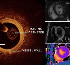 Women’s Heart Attack Research Program (HARP) shows combining OCT and cardiac MRI can detect the underlying cause of heart attack in women who did not have blocked arteries