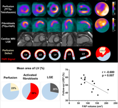Representative case with acute anterior wall myocardial infarction: Myocardial perfusion images using 99mTc-tetrofosmin at rest (first row), 68Ga-FAPI-46 PET (second row), late gadolinium enhancement (LGE) from cardiac magnetic resonance (third row) and schematic drawings of the left ventricle (fourth row). Area of fibroblast activation exceeds infarct area and LGE signal, most common type of myocardial FAP-distribution. Bottom left: Mean areas of perfusion defect, FAPI-signal and LGE of 35 studied patients