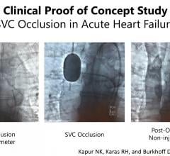 Novel Therapeutic Approach Effective at Reducing Pressure for Heart Failure Patients