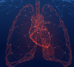 PH-HFpEF affects more than 1,600,000 North Americans, with estimates indicating a prevalence of more than 2,000,000 patients by 2030