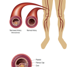 Novel bioresorbable scaffold system being developed for expanded indications