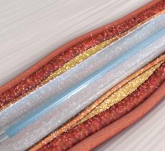 Virtue Sirolimus-Eluting Balloon Earns FDA Breakthrough Device Designation