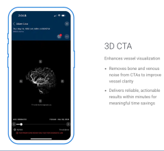 Viz.ai Launches Viz 3D CTA For Use in Stroke and Aneurysm Workflows