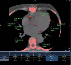 An example of a CT coronary artery calcium scoring exam showing how each vessel segment is scored to assess a patient's risk for a future heart attack. Example is from Philips Healthcare.