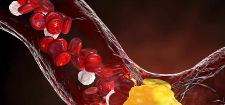 While reinforcing the importance of treating all known risk factors that contribute to atherosclerotic cardiovascular disease, ASCVD, physicians also need to recognize and treat systemic inflammation in CV disease, according to this guest column author who addresses the importance of identifying and reducing residual inflammatory risk.