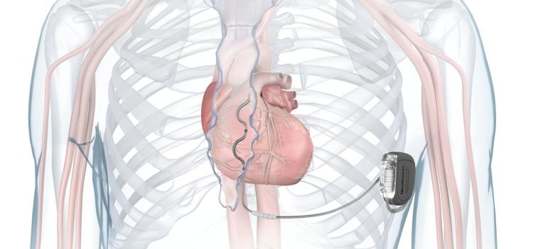 The Aurora EV-ICD system